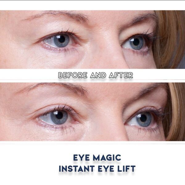 Before and After Eye Magic Eye Lift