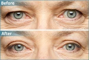 eye-magic-before-after1