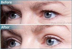 eye-magic-before-after 2