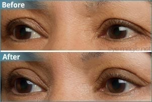 eye magic before after 3