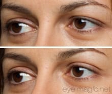 before and after eye magic