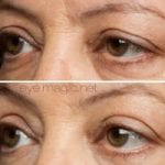 before and after eye magic 3