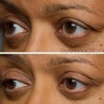 before and after eye magic 6