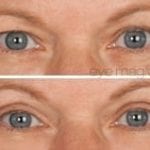 before and after eye magic