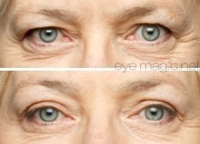 before: ptosis eyelids, after: eye magic eye lift
