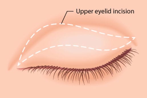 Upper Eyelid Surgery Incision Area