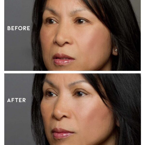 Before and After Eye Magic Asian Eyes
