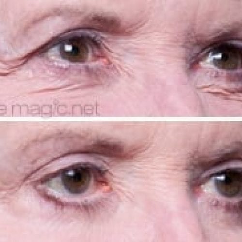 before and after eye magic 10
