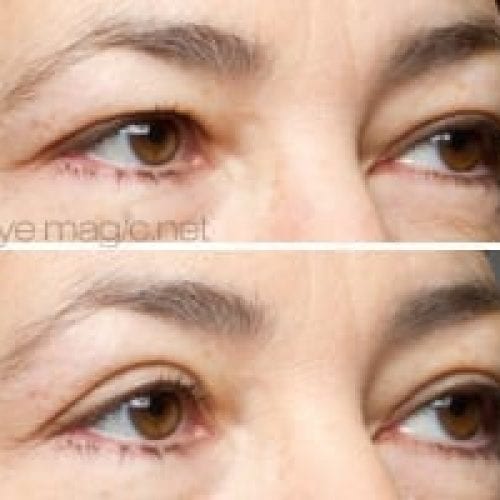 before and after eye magic 12